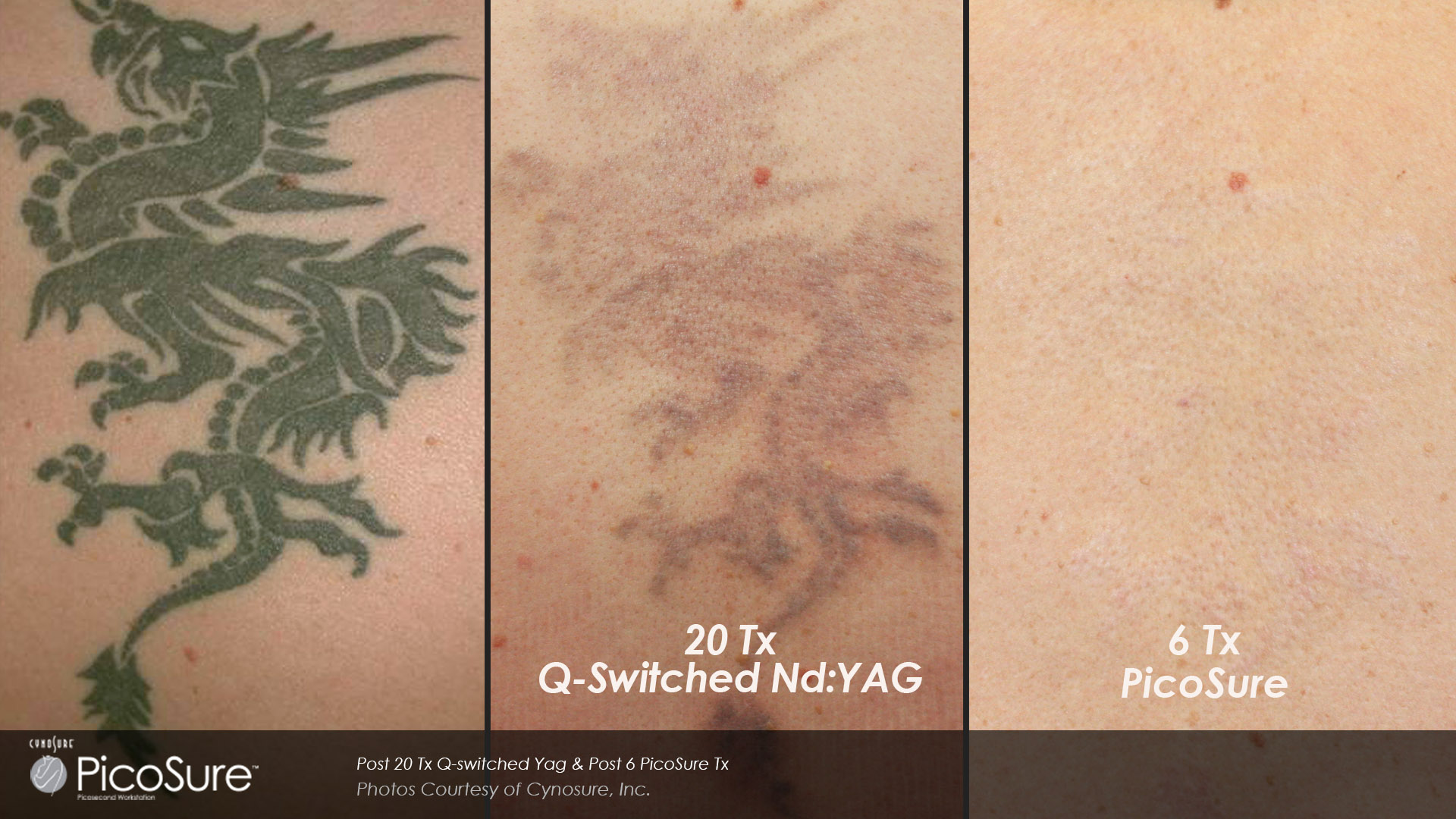 Laser Tattoo Removal Toronto - Press Release - Rice ...